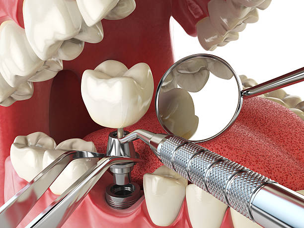 Best Emergency Wisdom Teeth Removal in Sparta, TN